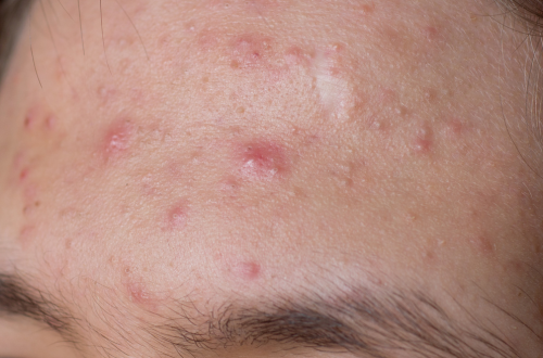 patient with allergy acne on forehead