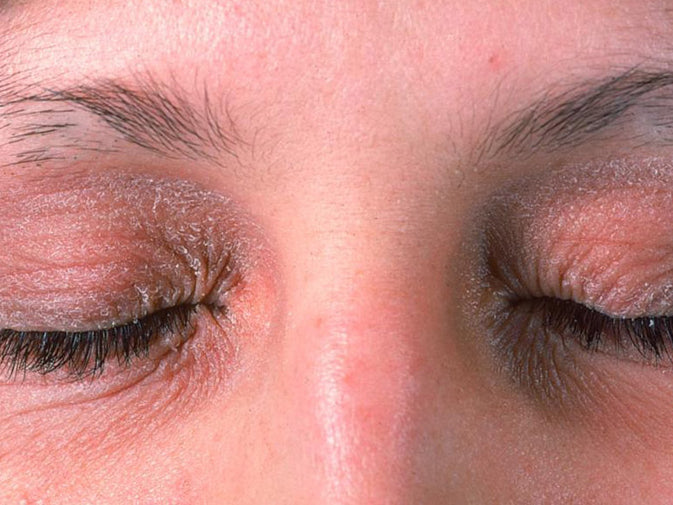 eyes with contact dermatitis, irritation of the skin