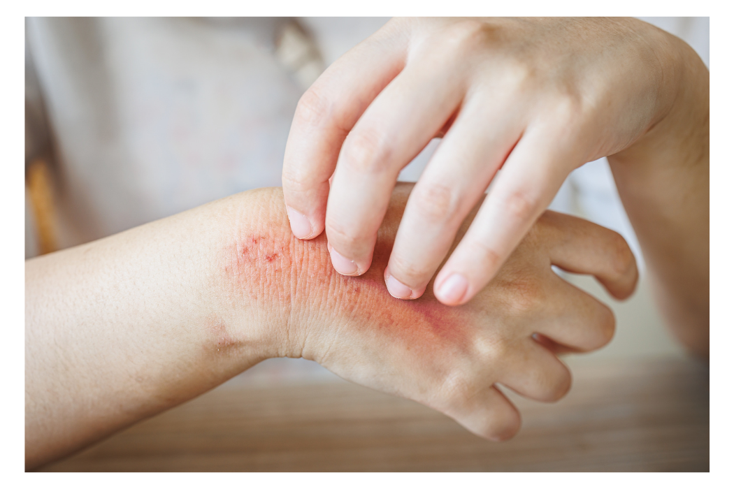 person scratching contact dermatitis reaction