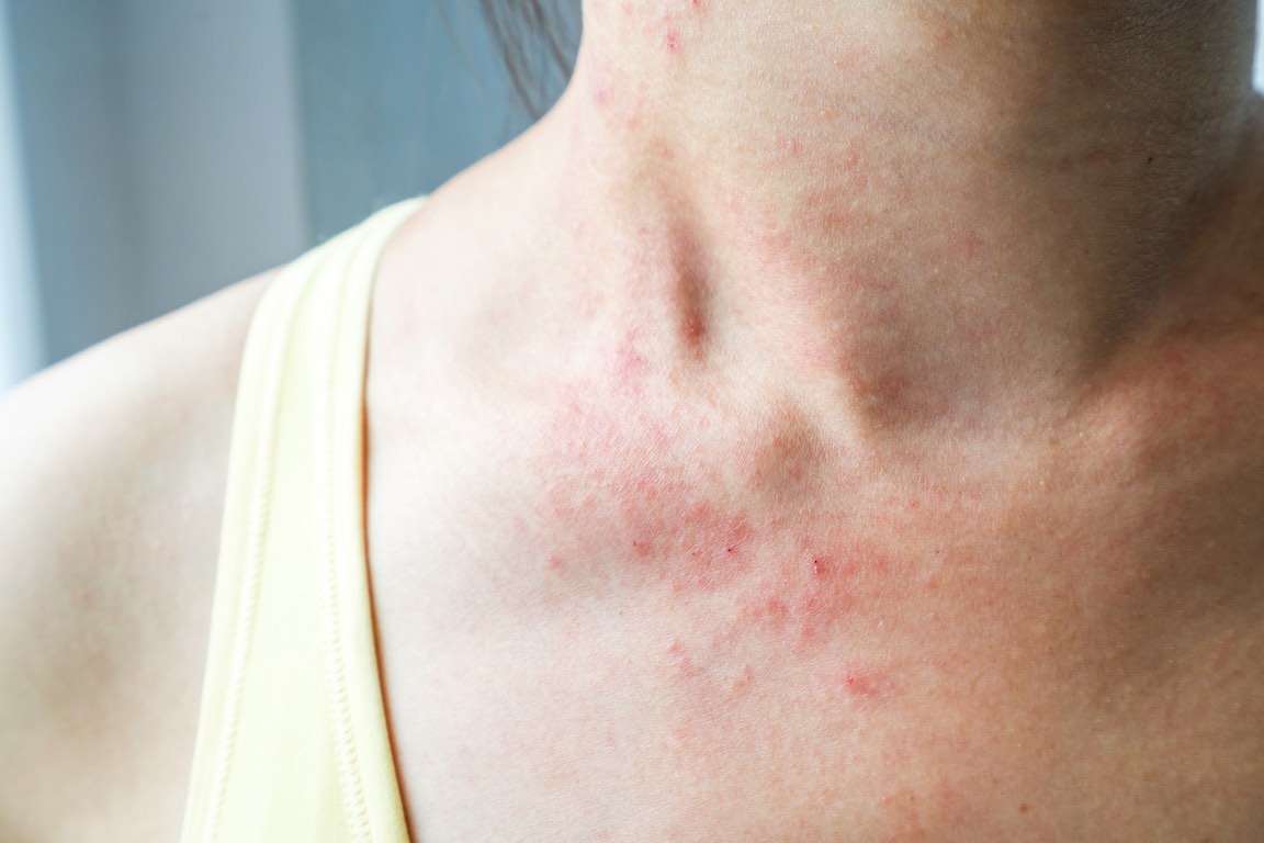 dry, flaking skin -- a common sign of eczema