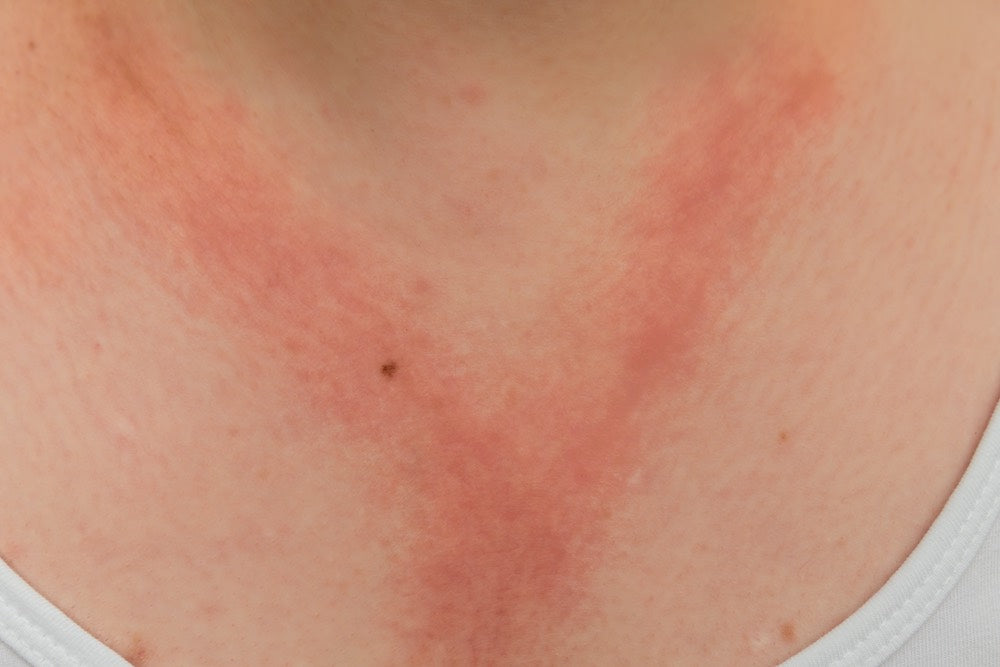 skin reaction caused by a nickel allergy